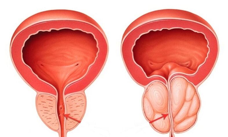 Healthy and inflamed prostatitis with prostatitis