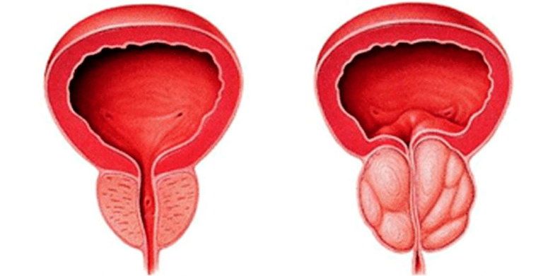 Normal and inflamed prostate gland